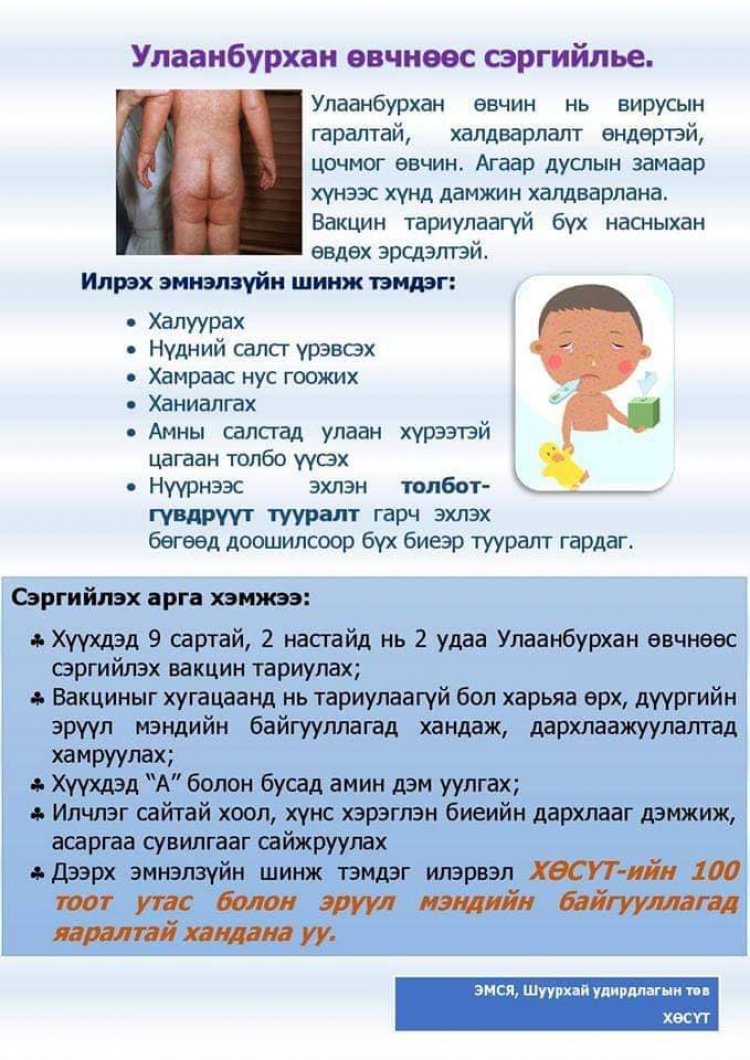 УЛААНБУРХАН ӨВЧНӨӨС СЭРГИЙЛЬЕ